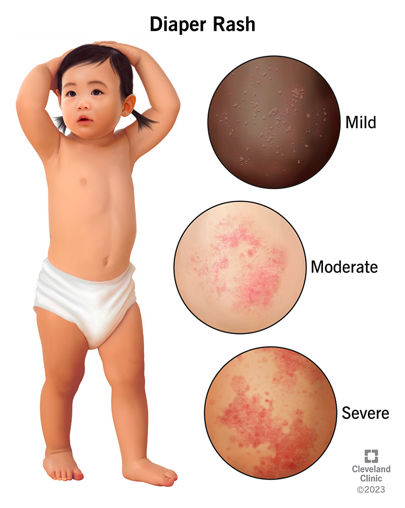 Diaper rashes, or diaper dermatitis, may be mild, moderate or severe.