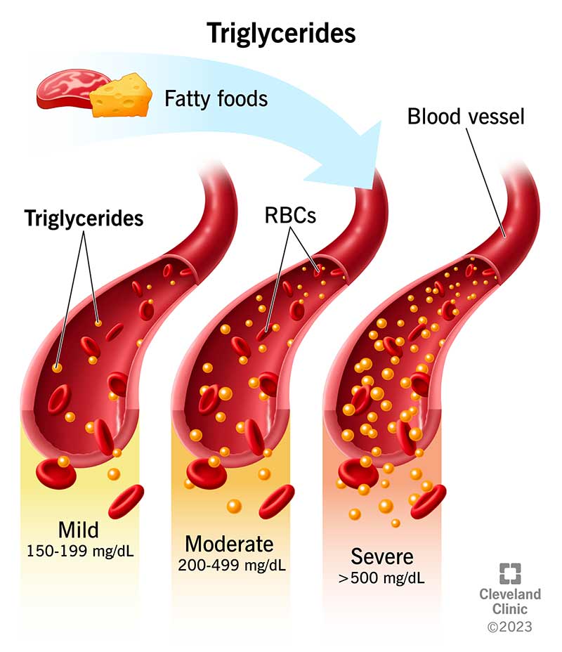 Triglycerides from fatty foods build up in your blood vessels.