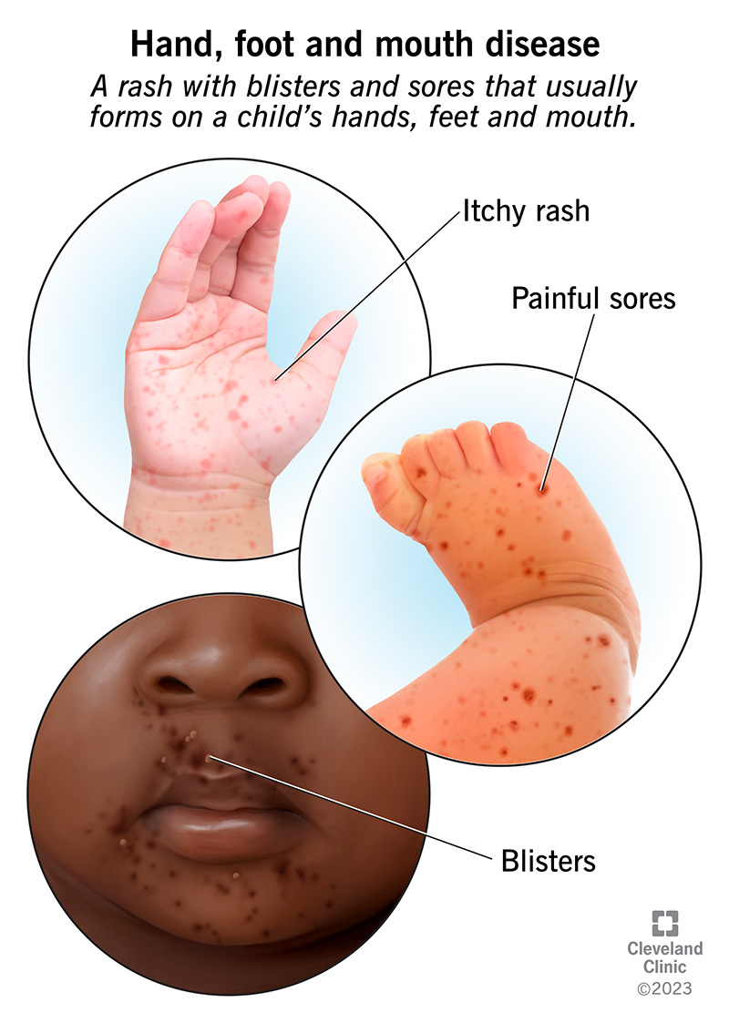 Rash, sores and blisters from hand, foot and mouth disease.