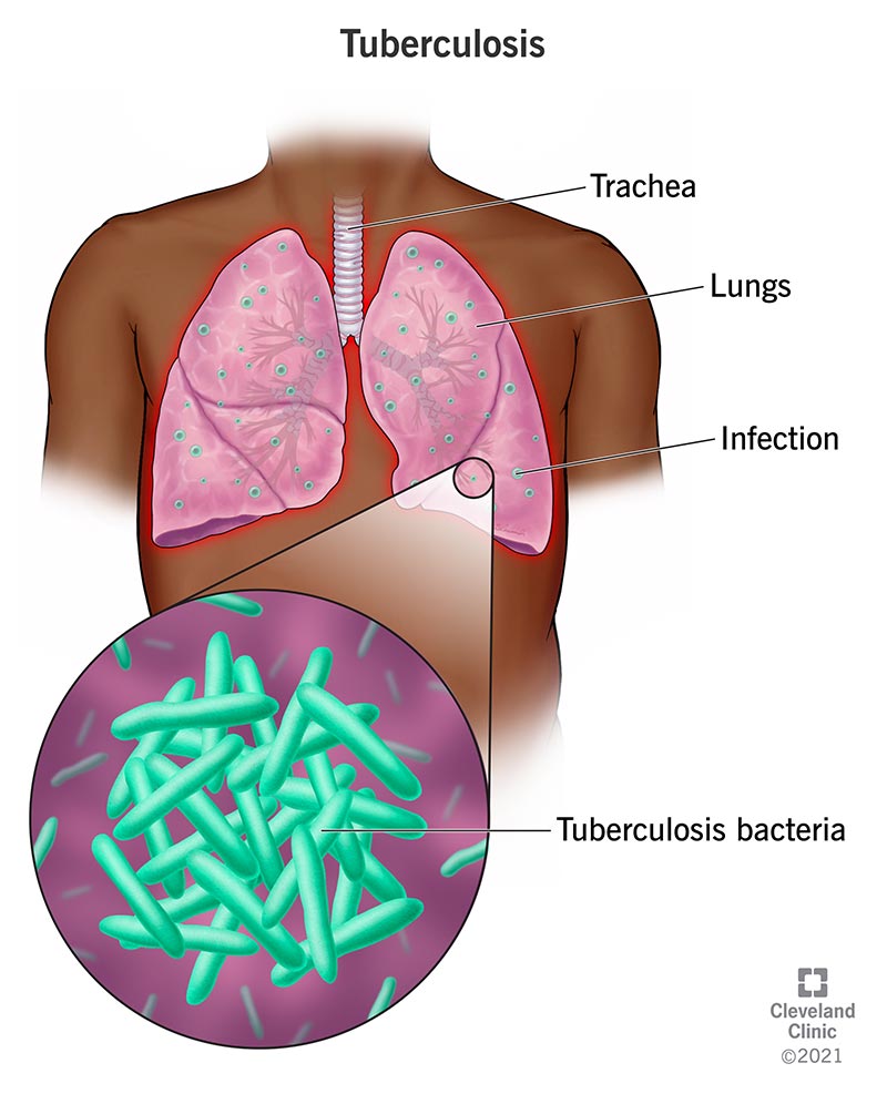 Your lungs, connected to your trachea, are infected with tuberculosis bacteria, causing tuberculosis.