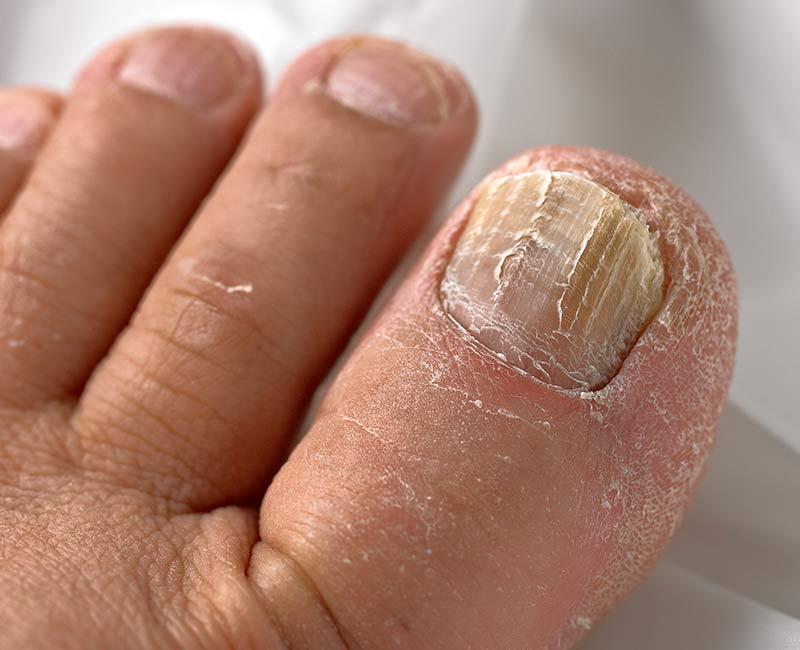 A toenail affected by fungus might look yellowish, brittle and cracked