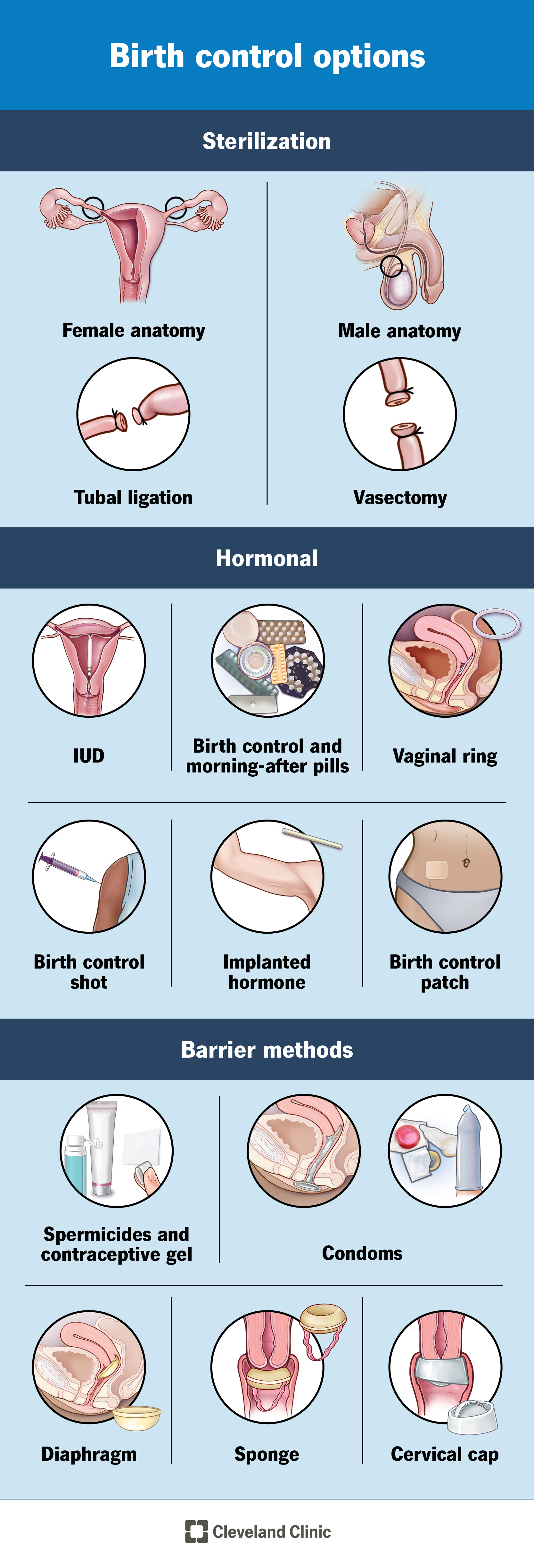 Chart of all the different types of birth control options.