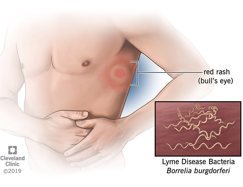 A reddish rash or skin lesion known as erythema migraines (EM) starts as a small red spot at the site of the tick bite.