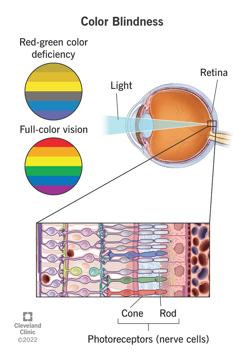 Illustration of the eye that shows the location of the retina and its specialized nerve cells (photoreceptors). A side illustration compares the colors a person sees with red-green color deficiency versus full-color vision.