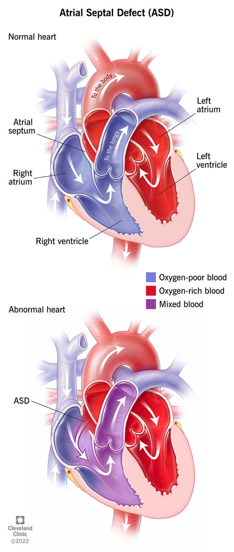 Illustration comparing a normal heart with a heart that has an atrial septal defect.