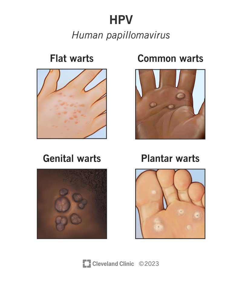 HPV (Human Papillomavirus): Causes, Symptoms & Treatment
