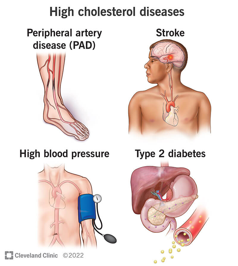 Illustration of diseases that are associated with high cholesterol.