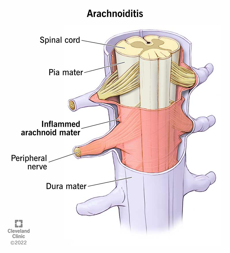 Anatomy of a section of the spine, showing the spinal cord, pia mater, inflamed arachnoid mater and the dura mater.