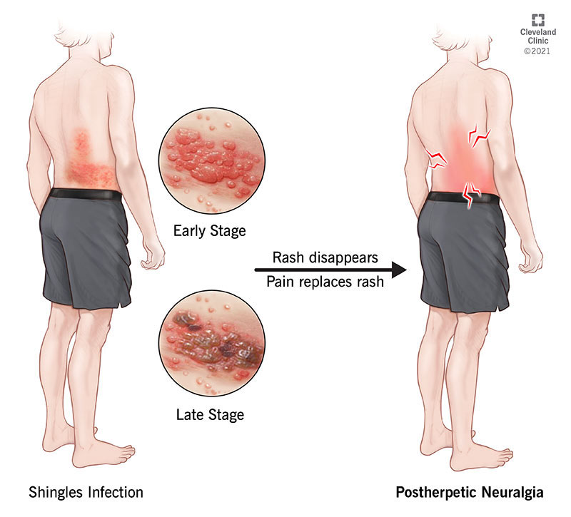 4 Infections That May Cause Back Pain: Integrated Body and