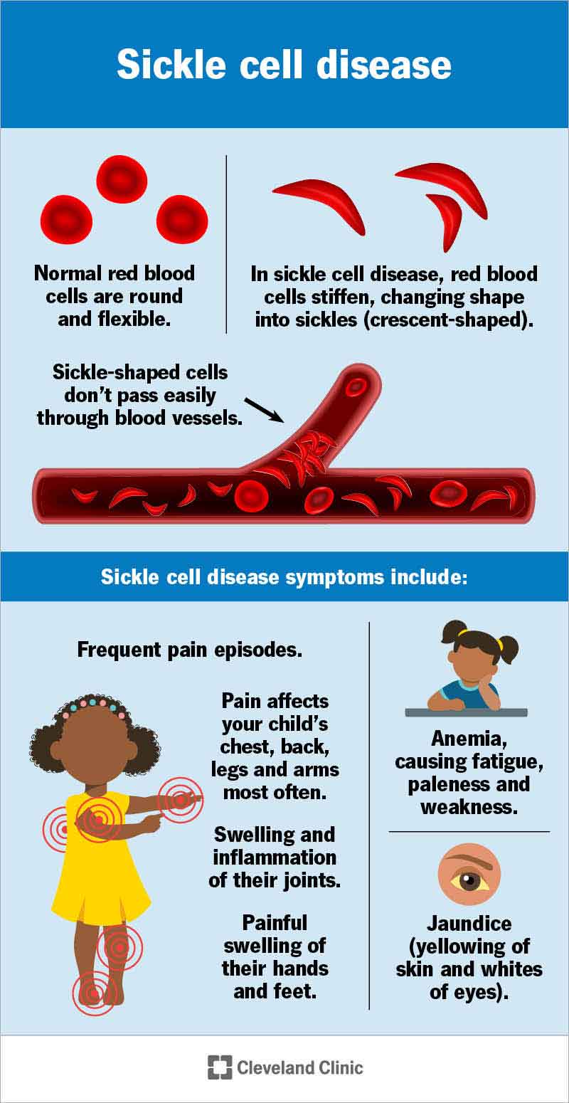 Sickle-shaped cells don’t pass easily through blood vessels, which can cause frequent pain episodes.