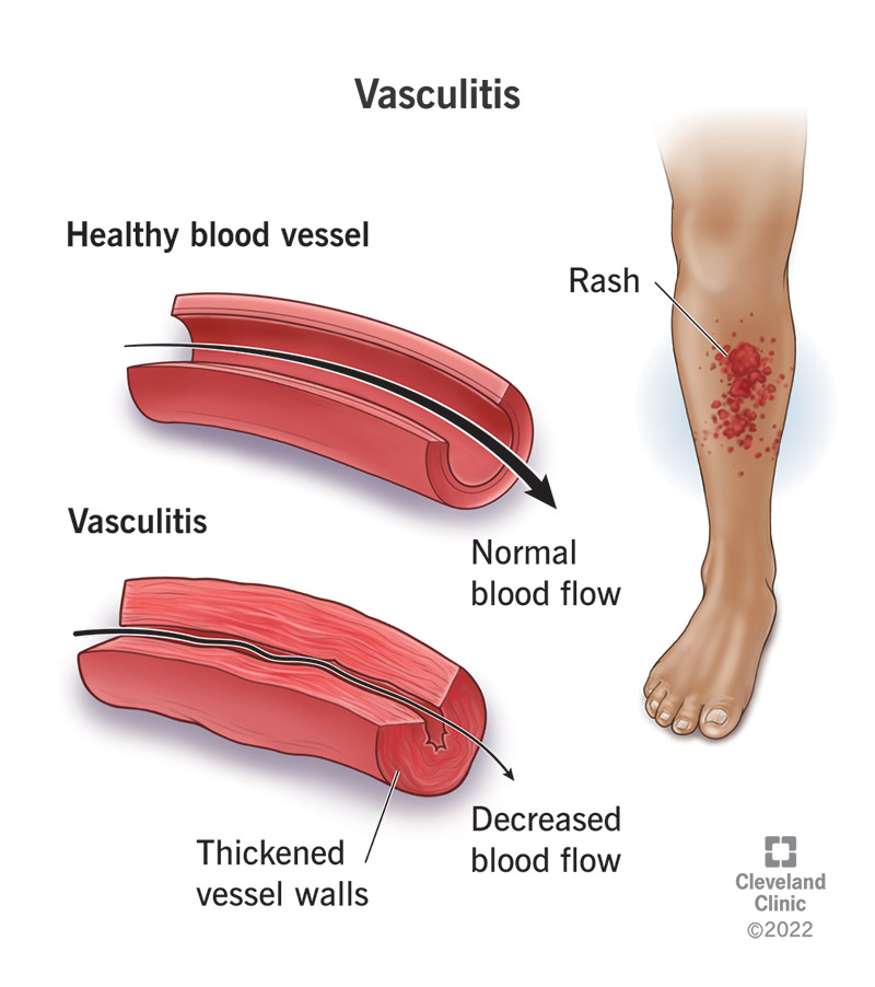 Vasculitis thickens your vessel walls, decreasing blood flow. Rashes and bumps can also result from vasculitis.