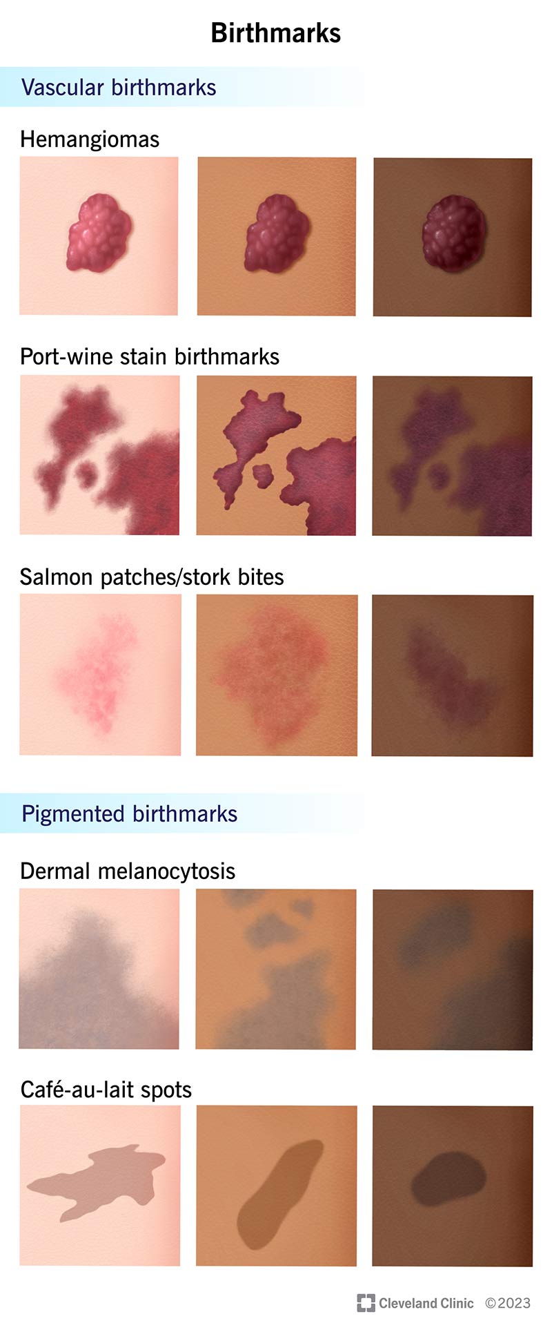 brown birthmarks