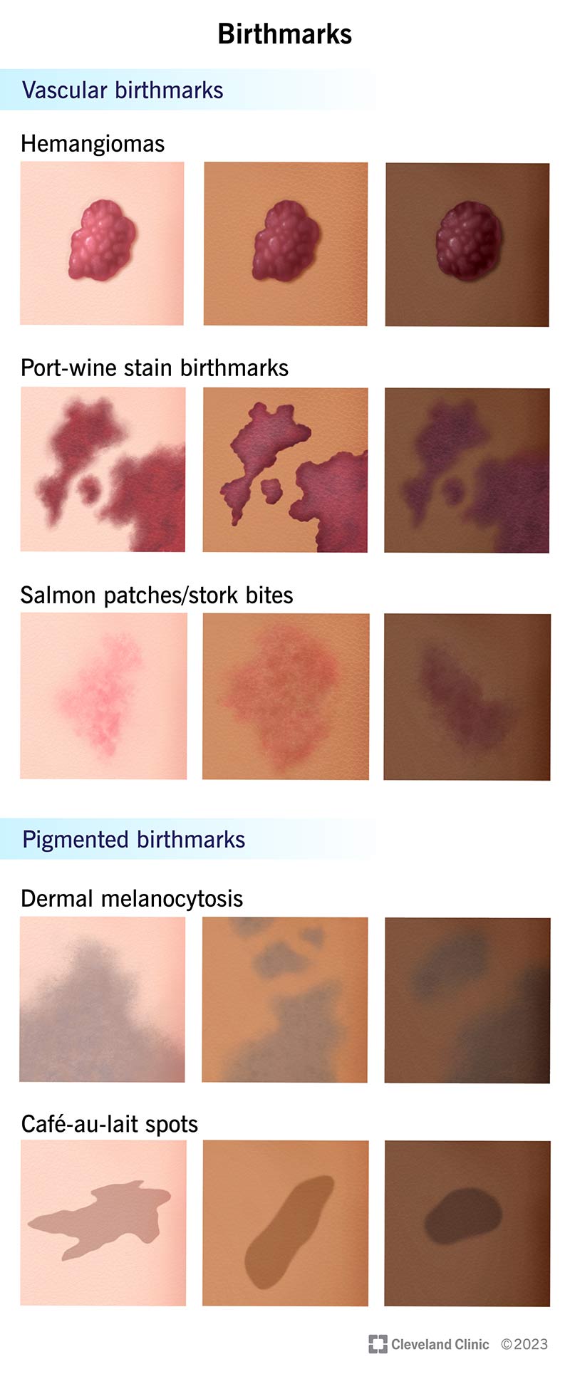 Several illustrations of five types of birthmarks on different skin tones.