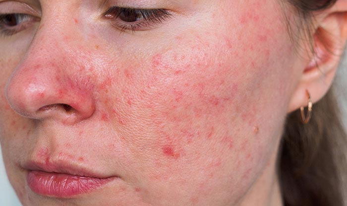 A person’s face, nose and cheeks show signs of rosacea.