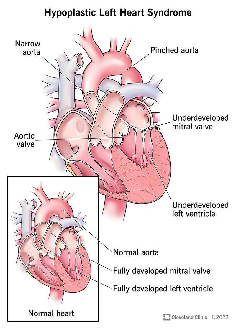 Differences between a normal heart and one with hypoplastic left heart syndrome