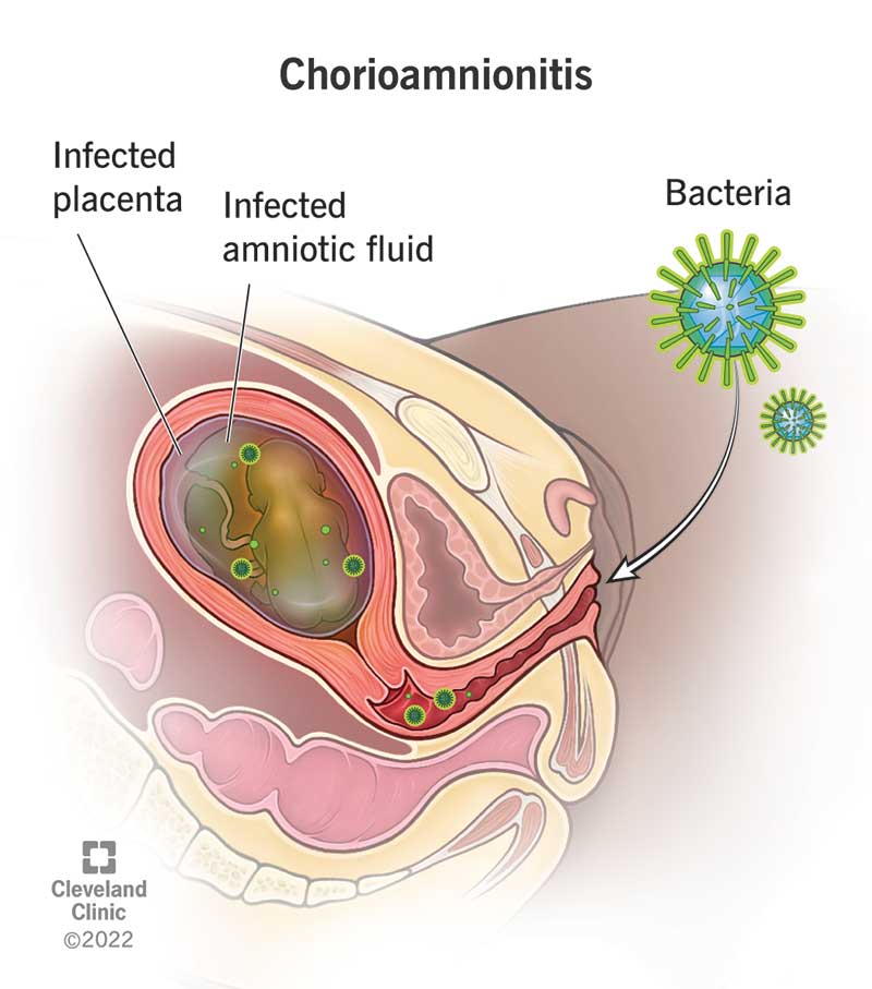 Chorioamnionitis: Causes, Symptoms, Diagnosis & Treatment