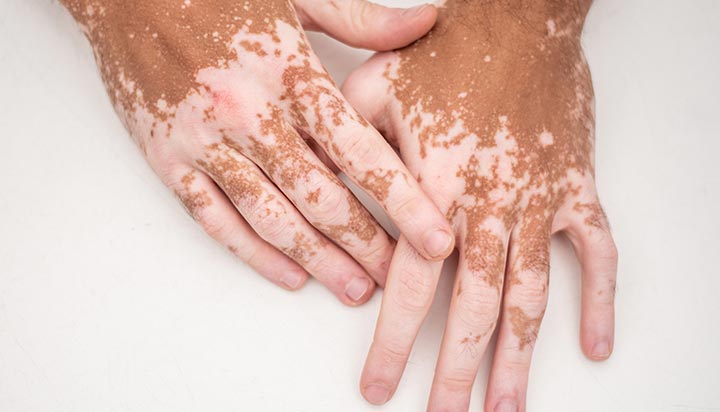 Vitiligo pigment loss on a person’s hands.