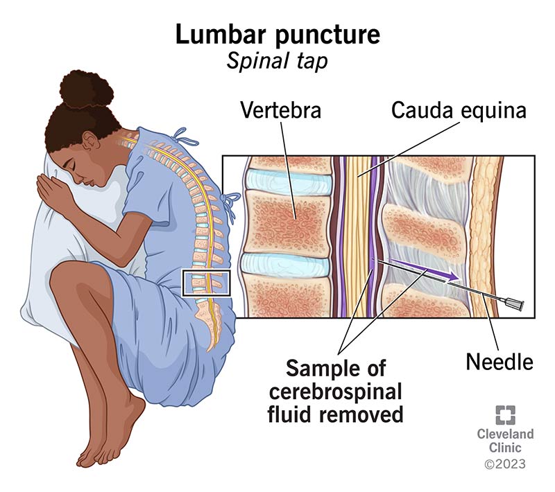 A person in the fetal position for a lumbar puncture (spinal tap) with a close look at cerebrospinal fluid removal