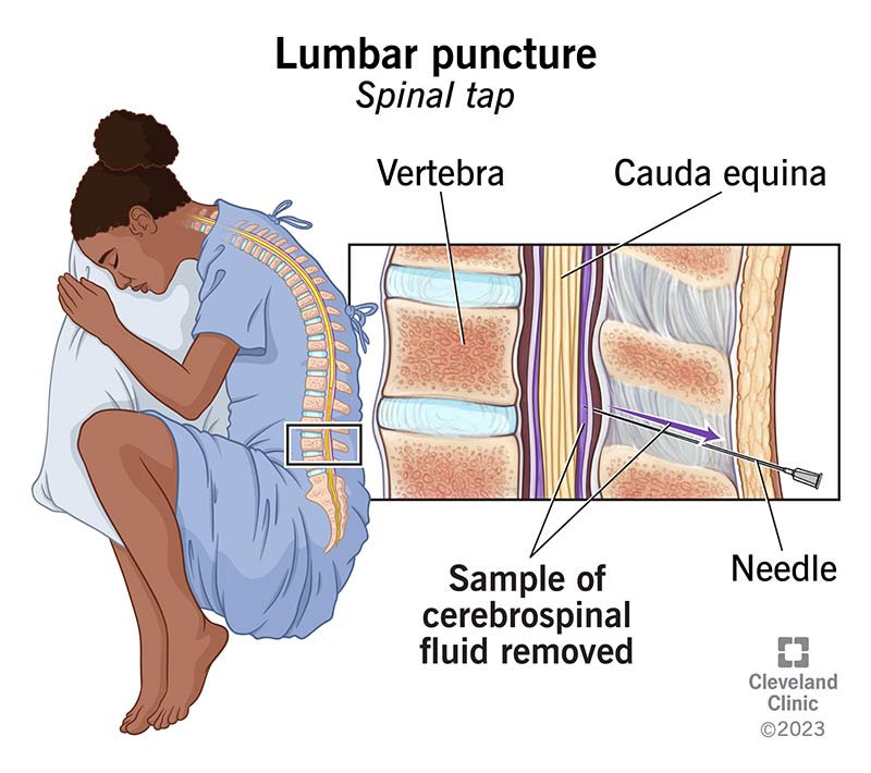 Lumbar puncture hot sale pictures