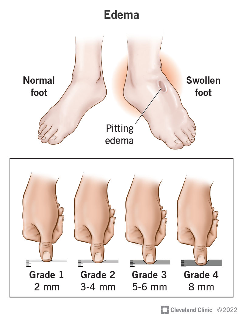 Edema is the medical term for swelling caused by fluid built up in your tissues. Swelling most often happens in your ankles and feet. Your provider will test the swollen area by performing a pitting test where they will press their finger into your swollen skin. A pitting test measures the speed of rebound and the depth to grade how much fluid is in your tissues.