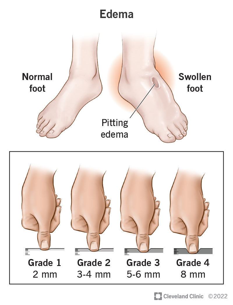 how-to-keep-ankles-from-swelling-aimsnow7