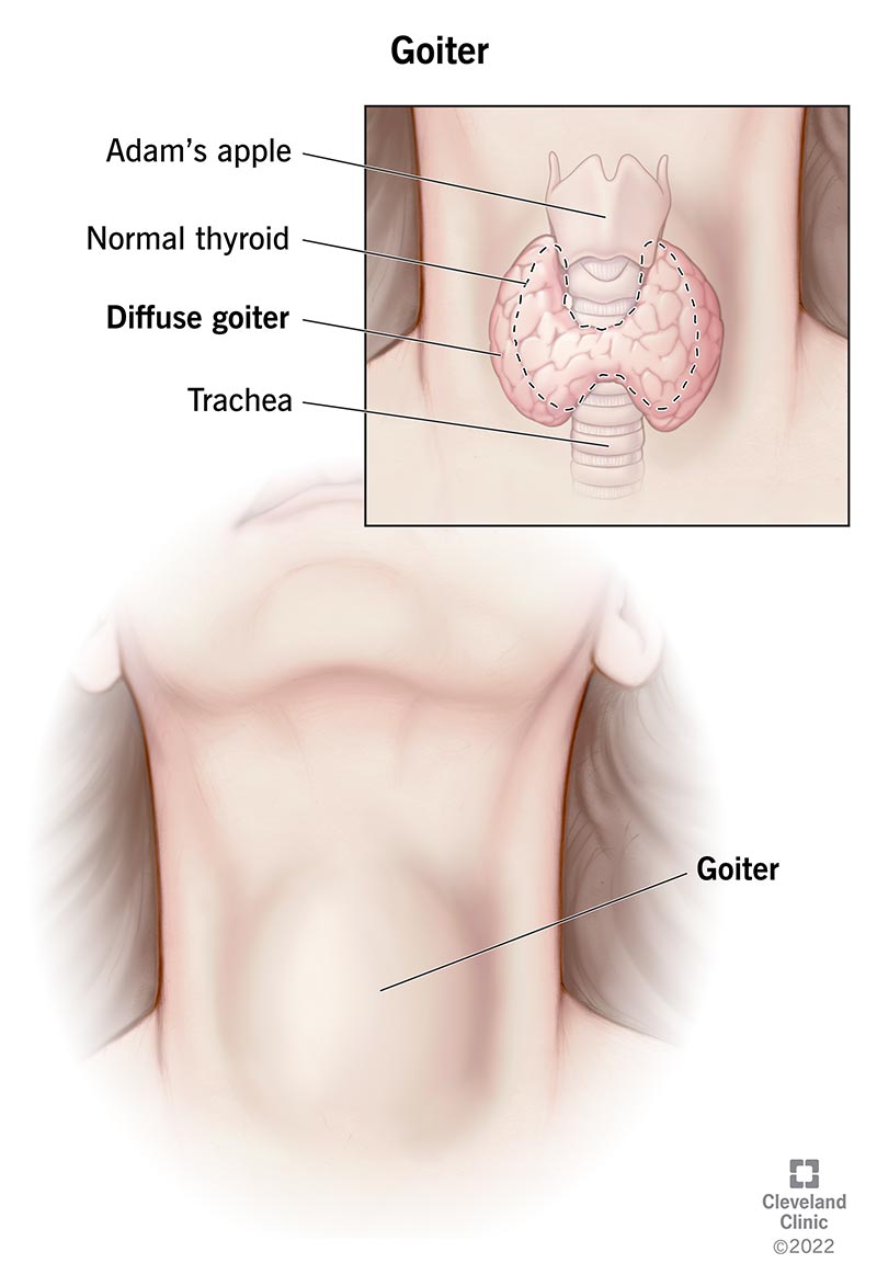 Illustration of the thyroid wrapped around the trachea in a person's neck showing the normal size of a thyroid and an enlarged size (goiter).