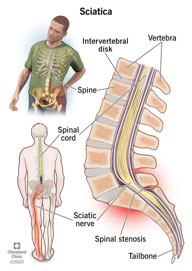 Sciatica Pain Relief - Take pressure off the sciatic nerve