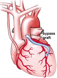 Heart Failure Surgery