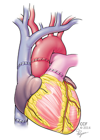 Heart transplant image