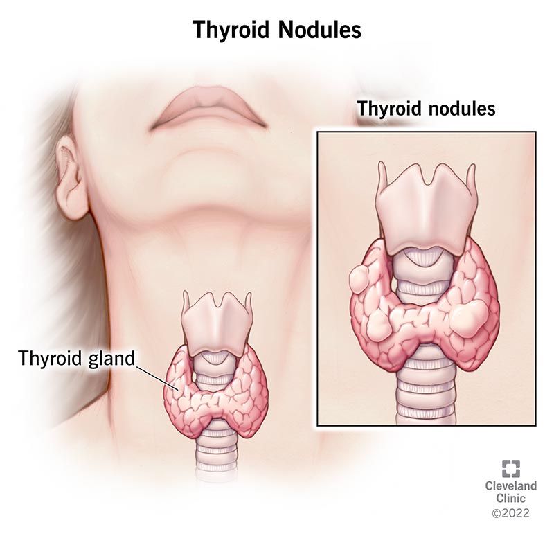 Illustration of thyroid gland position in a person's neck with a closeup of the thyroid gland with bumps on it, indicating thyroid nodules.