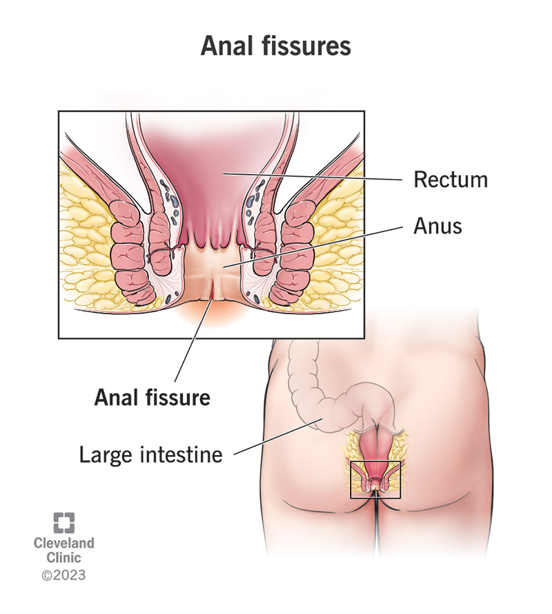 An anal fissure is a tear in the inside of your anus.