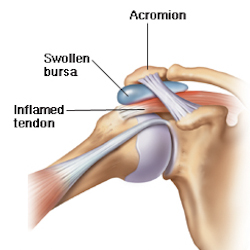 torn bursa shoulder symptoms