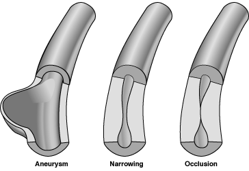 polyarteritis nodosa