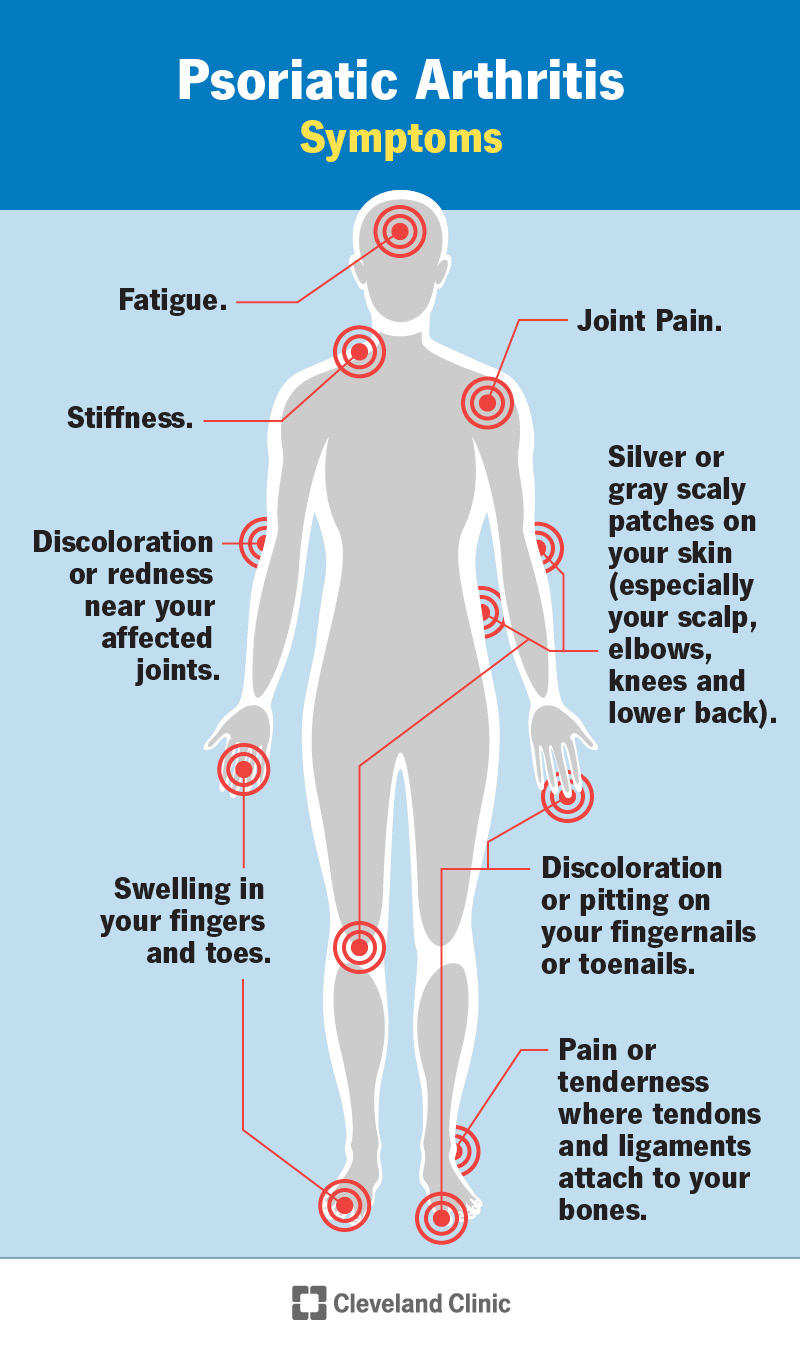 An illustration showing psoriatic arthritis symptoms and where they can affect your body.