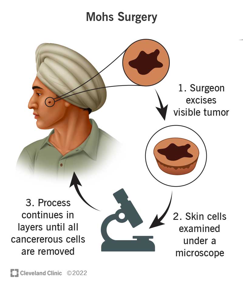 In Mohs surgery, your surgeon cuts away the skin cancer (tumor) and examines the cells under a microscope. The surgeon continues to cut and check the margins until all cancerous cells are removed.