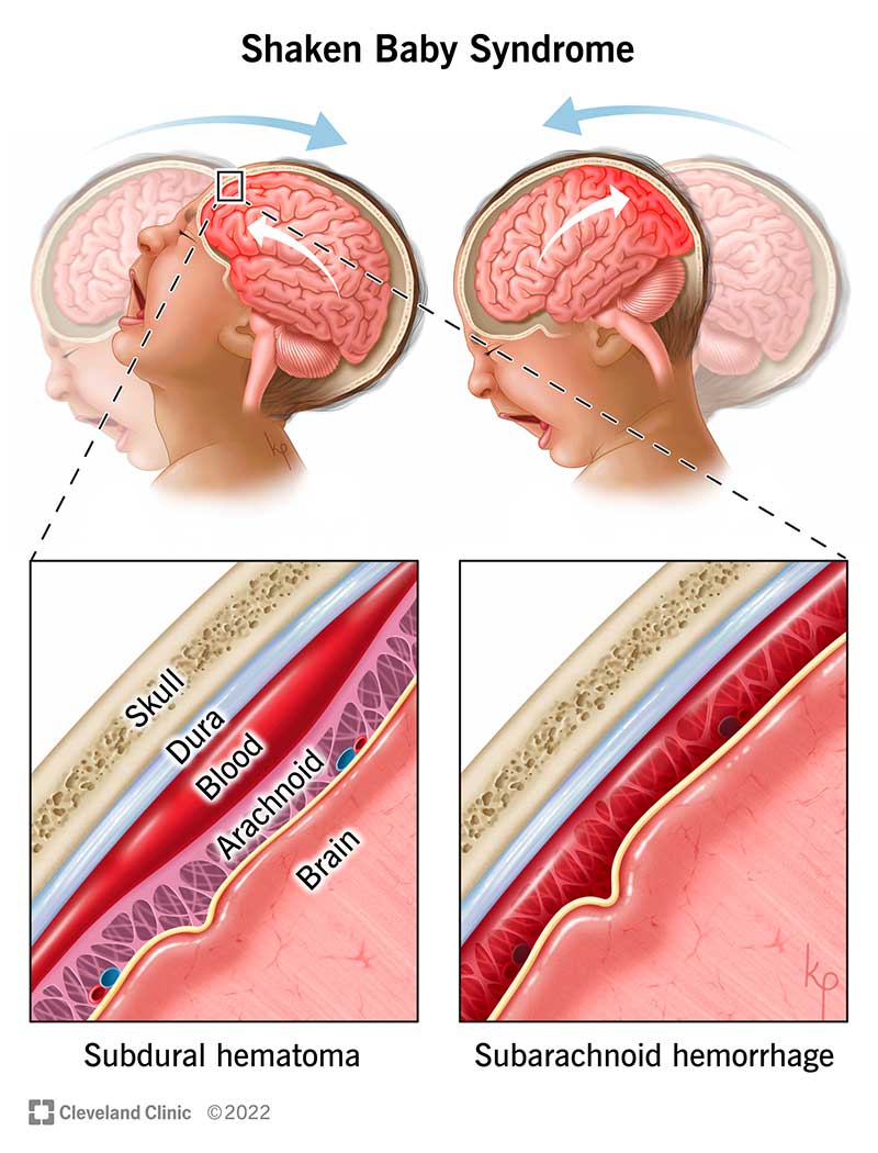 Shaken Baby Syndrome Abusive Head Trauma Symptoms Causes