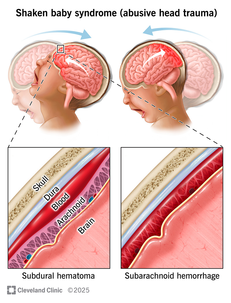 Shaking a baby can cause bleeding between their brain and dura (subdural hematoma) and bleeding between their brain and arachnoid (subarachnoid hemorrhage).