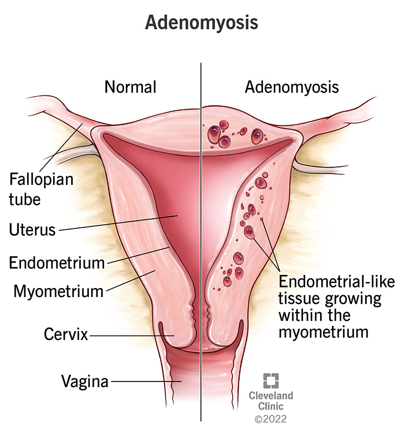 Endometrial tissue growing into the myometrium or muscular wall of your uterus.