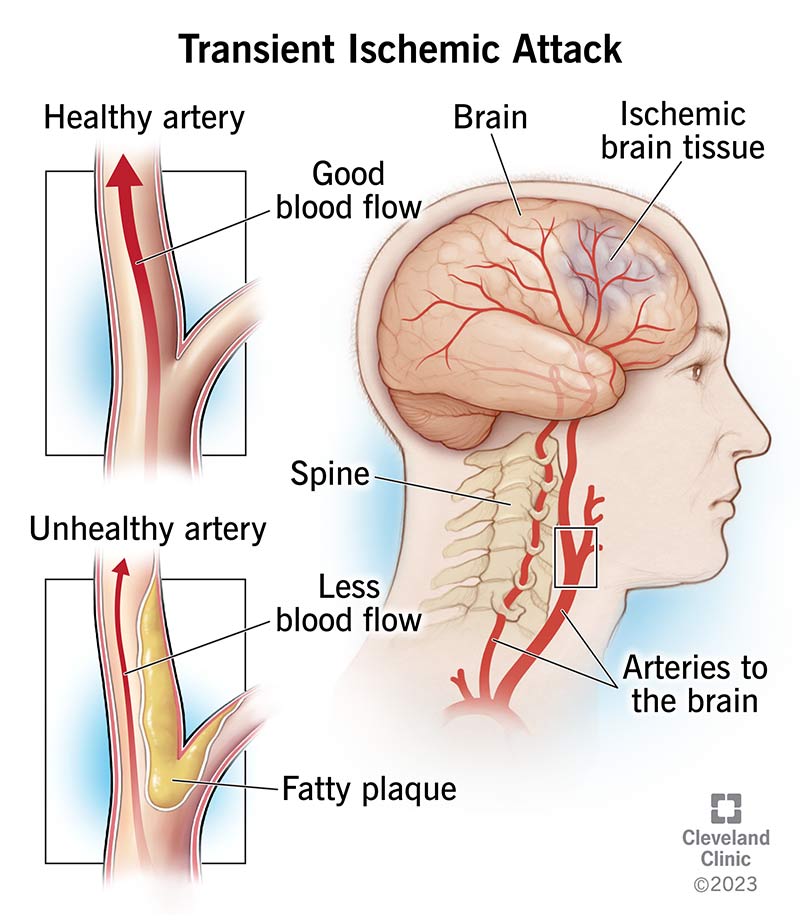 Transient ischemic attack causes temporary symptoms because there’s Reduced blood flow to parts of your brain.