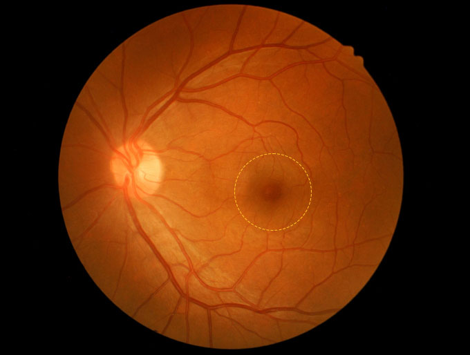 The macula, which is the center of the retina of your eye, can develop a gap, which is called a macular hole.