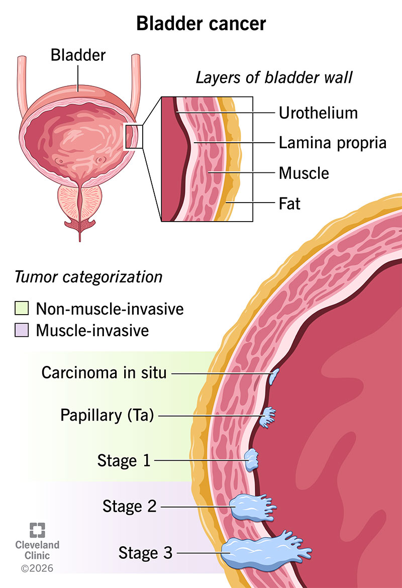 Anatomical bladder and bladder wall, with layers impacted during each bladder cancer stage