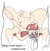 Male Sling Procedure