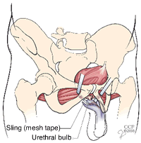 The male sling procedure uses surgical tape around the urethral bulb to elevate and reinforce your urethra and bladder neck