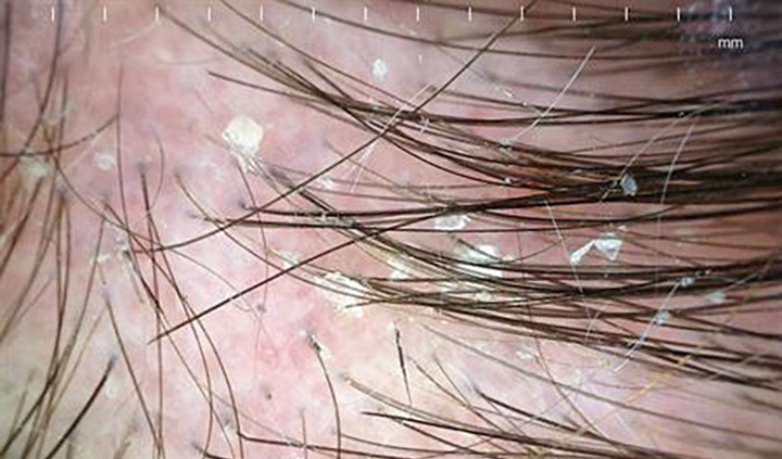 Seborrheic dermatitis scales within a person’s hair.