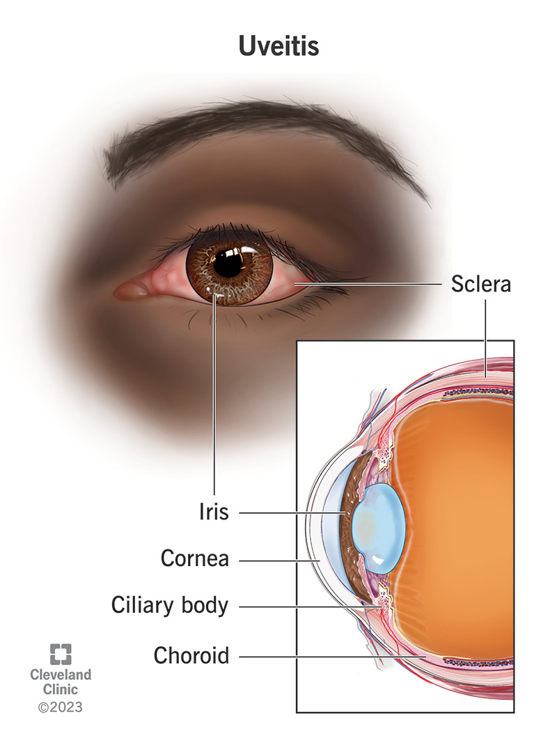 The iris, ciliary body and choroid make up the uvea of your eye, and uveitis is inflammation of one or more of those three