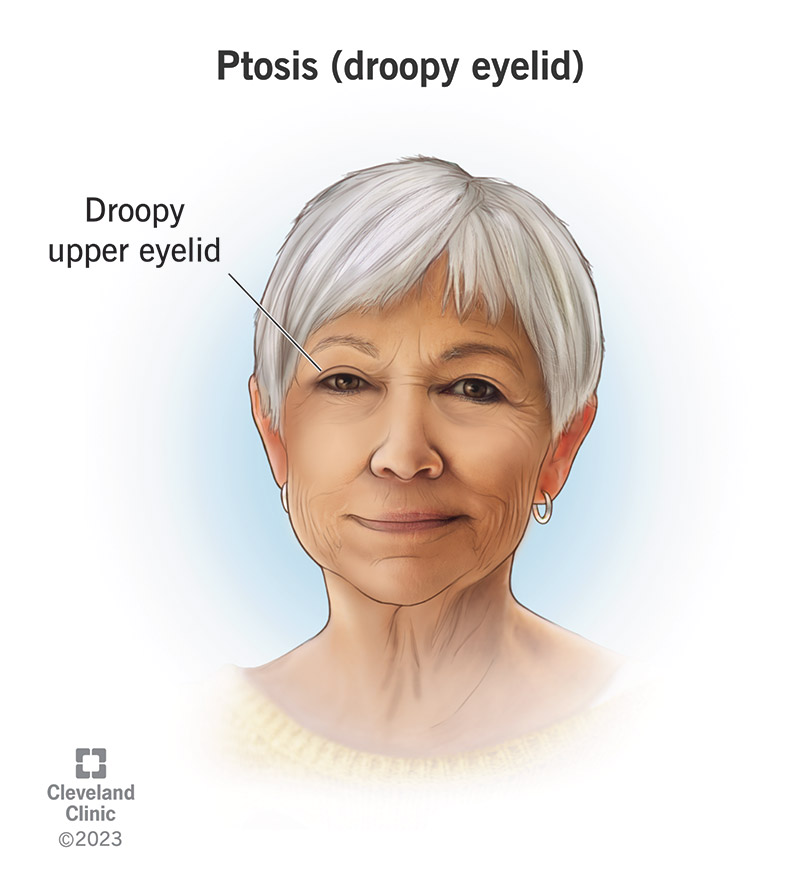 A person with a droopy eyelid (ptosis).