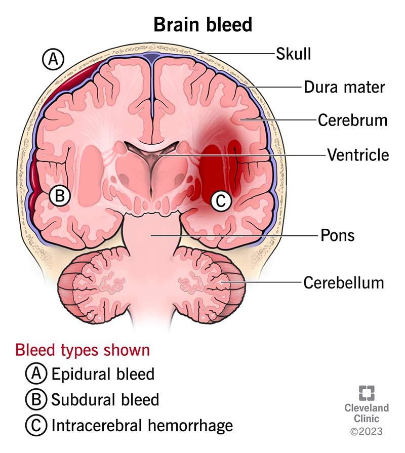 A diagram of the brain and three types of a brain bleed.