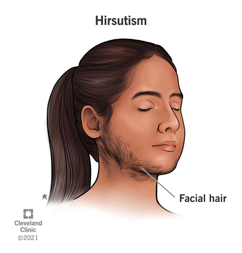 A woman with thick, dark hair along her jawline, chin and the top of her neck that is caused by Hirsutism
