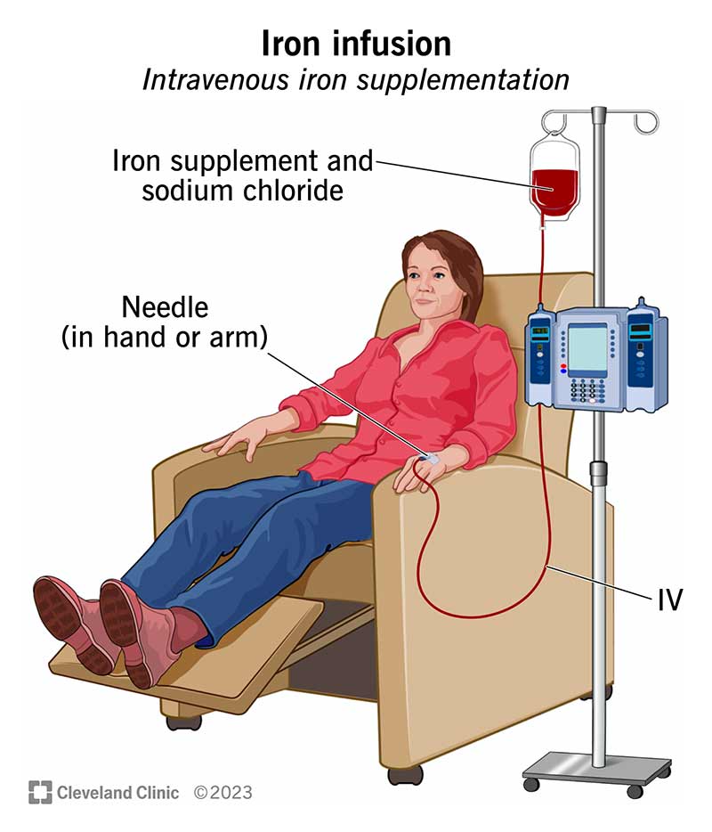 A person receives an iron infusion through an IV in their hand.