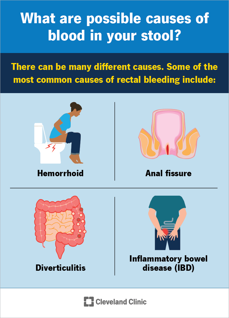 Common causes of blood in your stool are hemorrhoids, anal fissures and IBD